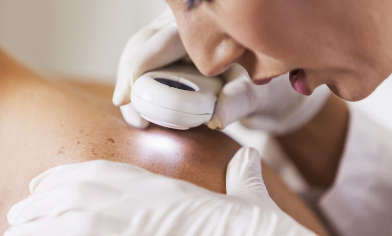 Καρκίνος του δέρματος: Τα «σιωπηλά» σημάδια που πολλοί αγνοούν