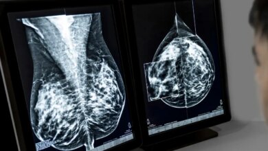 Η τεχνητή νοημοσύνη μπορεί να ανιχνεύει την καρδιοπάθεια στις μαστογραφίες
