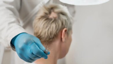 Φάρμακο για την αρθρίτιδα μπορεί να αντιμετωπίζει την σοβαρή τριχόπτωση