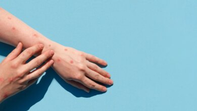ΗΠΑ: 4ος θάνατος λόγω της επιδημίας ιλαράς στην Πενσιλβάνια