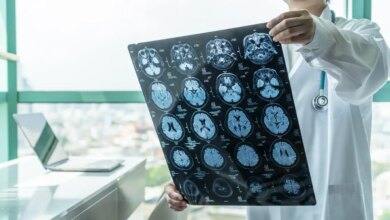 Η τεχνητή νοημοσύνη προβλέπει τον κίνδυνο εγκεφαλικού από το DNA των ασθενών