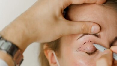 Βλεφαροπλαστική: Το ξεκούραστο βλέμμα χωρίς να αλλάζει το πρόσωπο